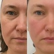 Аппаратный лифтинг массаж лица БМС  - Кабинет здоровья
